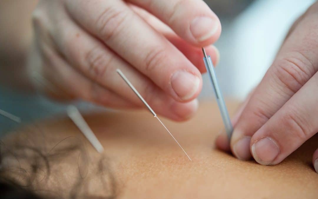 Acupuncture: 5 Benefits Against Chronic Pains in the Body